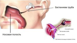 Болезни слуховой трубы