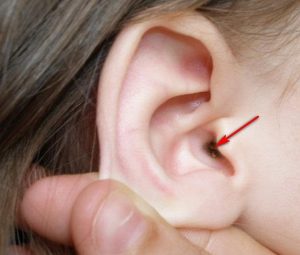 серная пробка у ребенка фото
