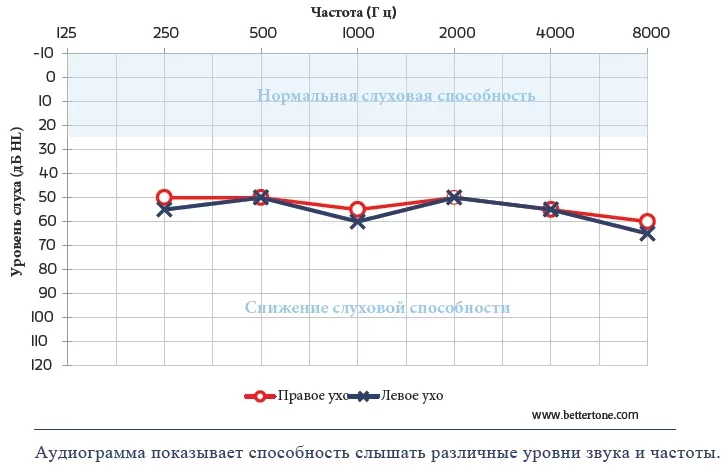 Типы потери слуха