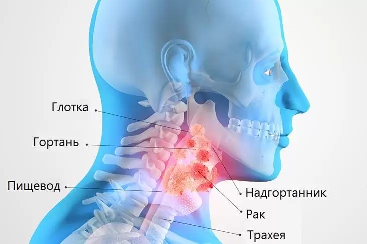 Рак горла: причины, симптомы, лечение