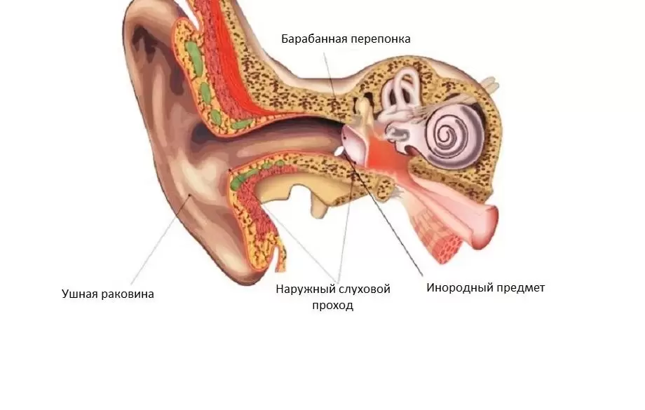 Як дістати чужорідний предмет з вуха дитини?