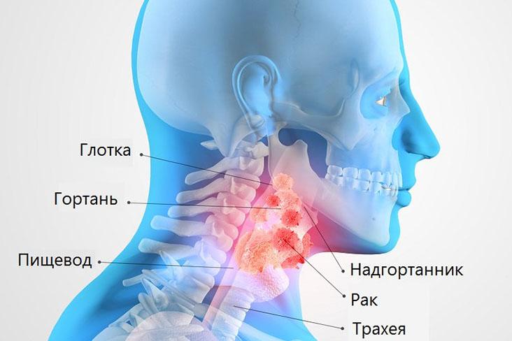 Уход после операции на гортани